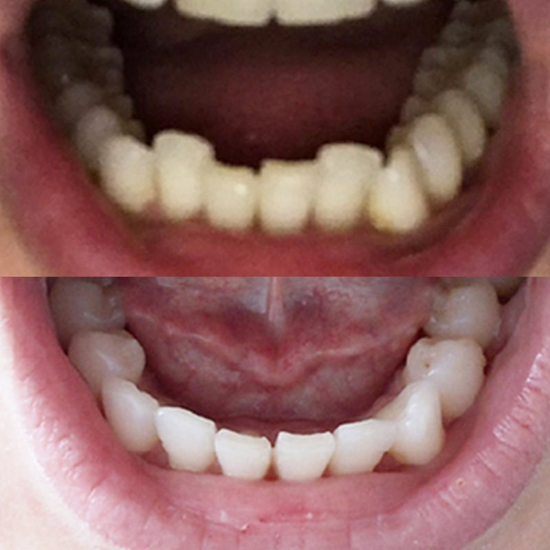 Straighten Your Teeth at Home with Invisible Aligners