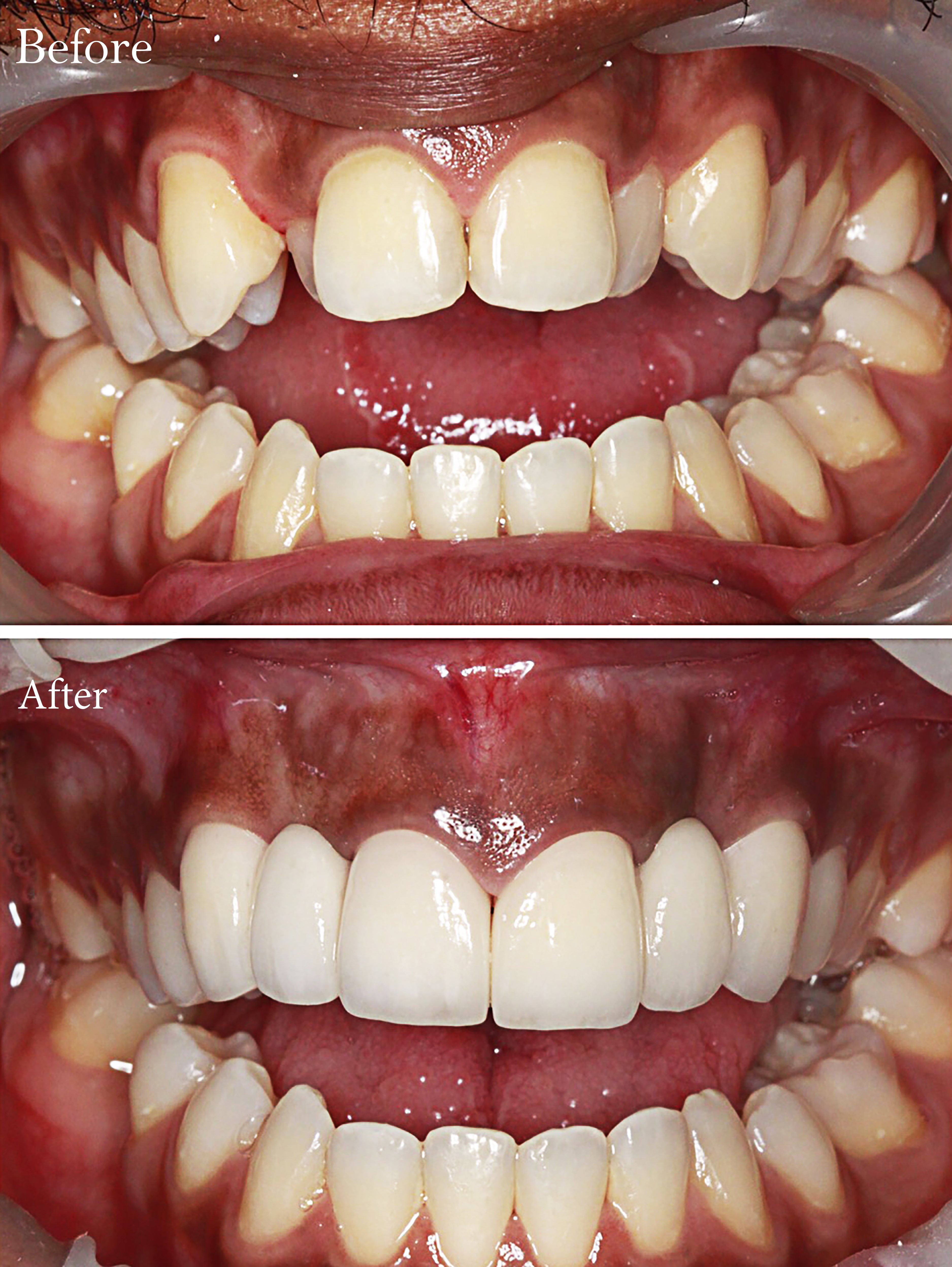 Straighten Your Teeth at Home with Invisible Aligners